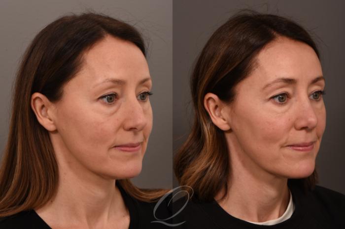 Rhinoplasty Case 1001839 Before & After Right Oblique | Serving Rochester, Syracuse & Buffalo, NY | Quatela Center for Plastic Surgery