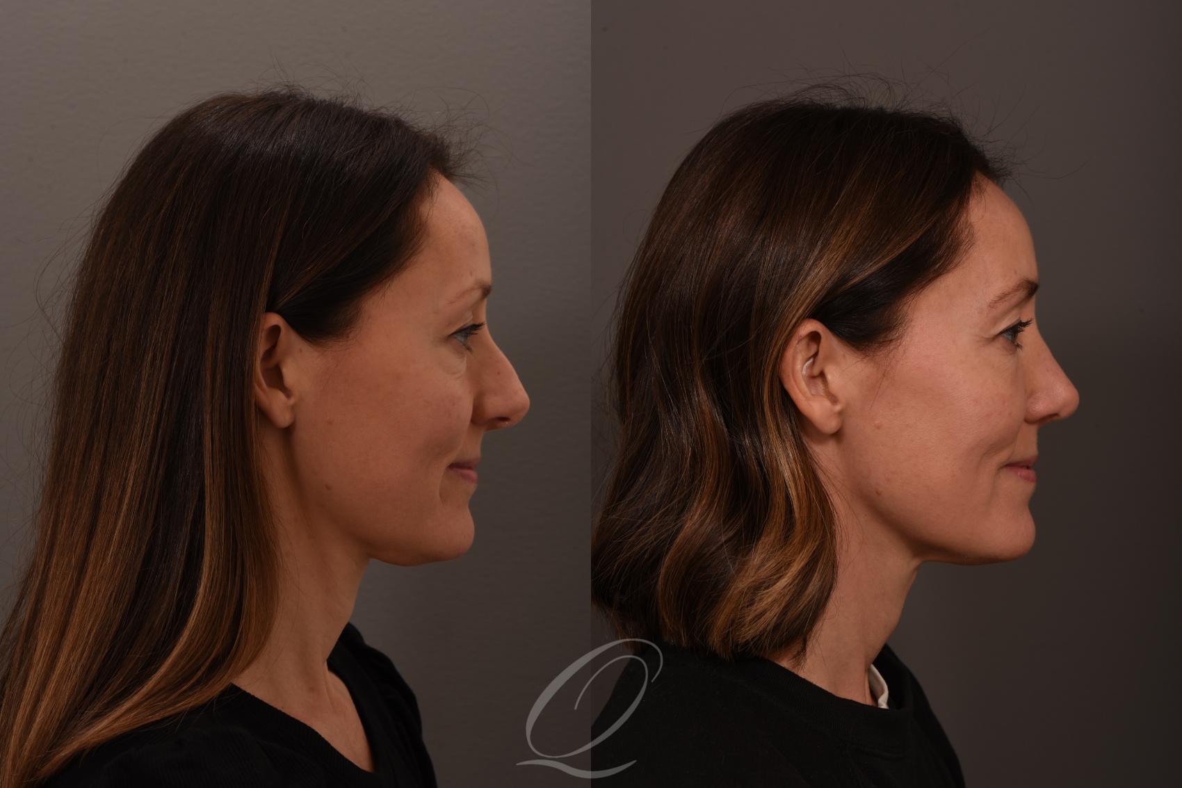 Rhinoplasty Case 1001839 Before & After Right Side | Serving Rochester, Syracuse & Buffalo, NY | Quatela Center for Plastic Surgery