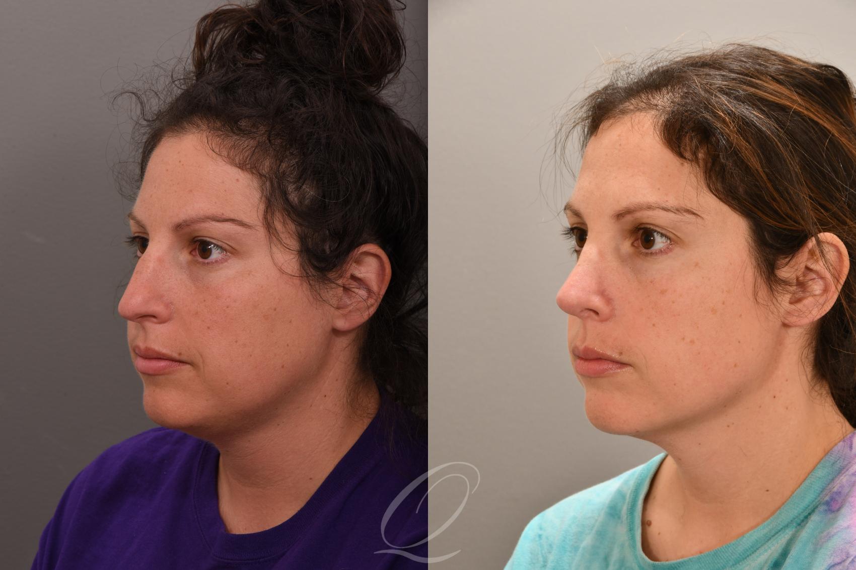 Rhinoplasty Case 1001862 Before & After Left Oblique | Serving Rochester, Syracuse & Buffalo, NY | Quatela Center for Plastic Surgery