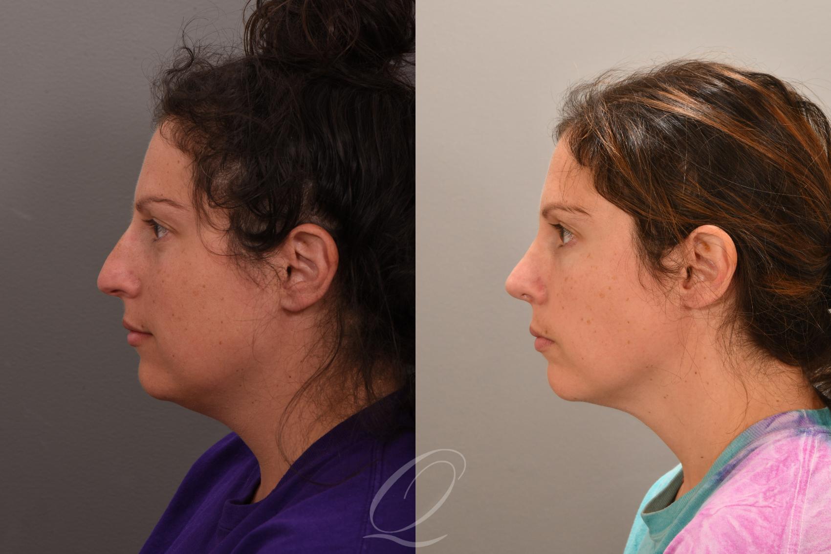 Rhinoplasty Case 1001862 Before & After Left Side | Serving Rochester, Syracuse & Buffalo, NY | Quatela Center for Plastic Surgery