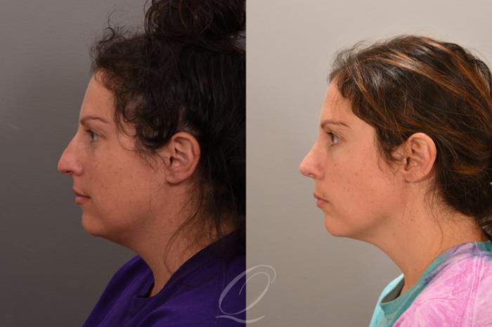 Rhinoplasty Case 1001862 Before & After Left Side | Serving Rochester, Syracuse & Buffalo, NY | Quatela Center for Plastic Surgery
