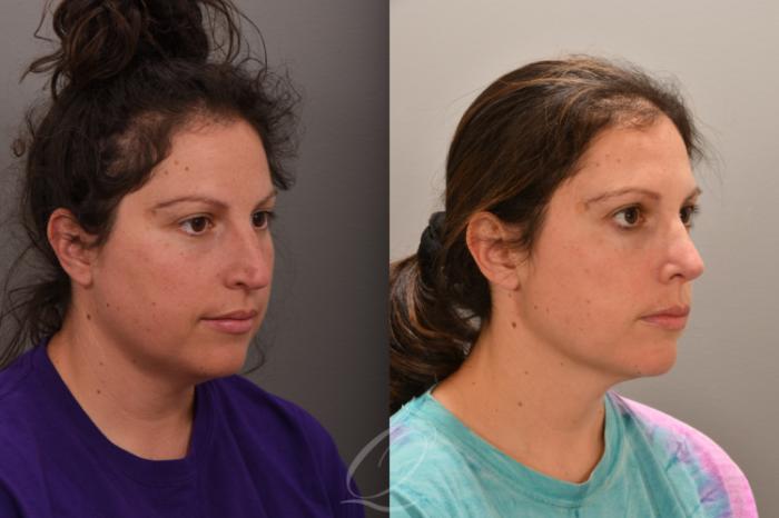 Rhinoplasty Case 1001862 Before & After Right Oblique | Serving Rochester, Syracuse & Buffalo, NY | Quatela Center for Plastic Surgery