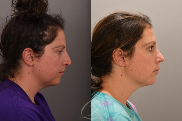 Rhinoplasty Case 1001862 Before & After Right Side | Serving Rochester, Syracuse & Buffalo, NY | Quatela Center for Plastic Surgery