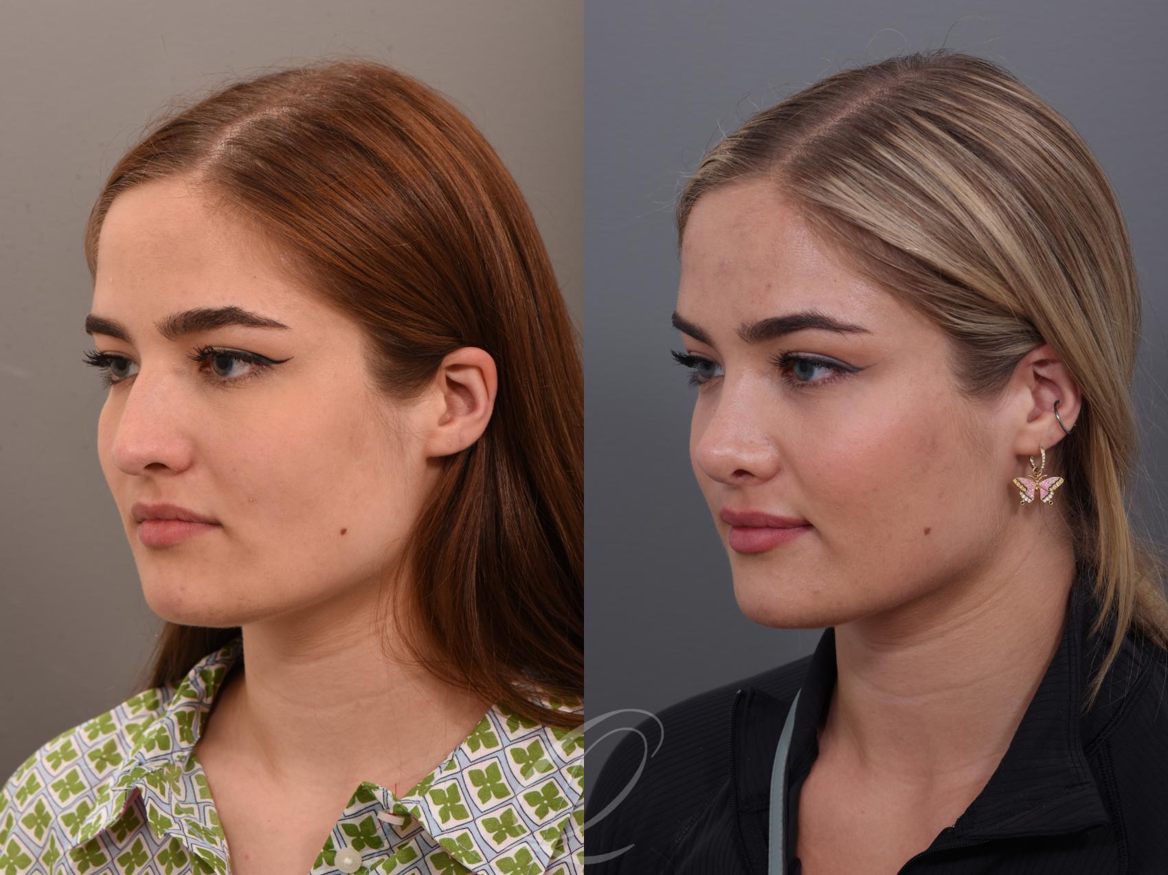 Rhinoplasty Case 1001890 Before & After Front | Serving Rochester, Syracuse & Buffalo, NY | Quatela Center for Plastic Surgery