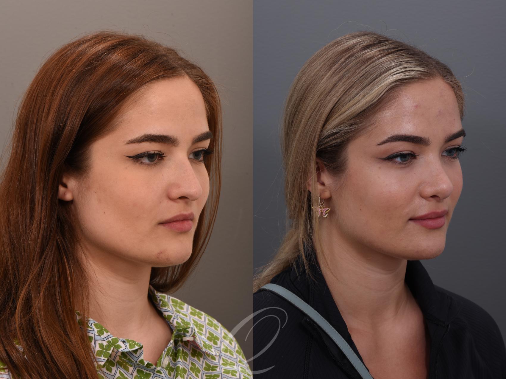 Rhinoplasty Case 1001890 Before & After Left Oblique | Serving Rochester, Syracuse & Buffalo, NY | Quatela Center for Plastic Surgery