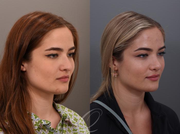Rhinoplasty Case 1001890 Before & After Left Oblique | Serving Rochester, Syracuse & Buffalo, NY | Quatela Center for Plastic Surgery
