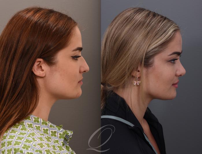 Rhinoplasty Case 1001890 Before & After Left Side | Serving Rochester, Syracuse & Buffalo, NY | Quatela Center for Plastic Surgery