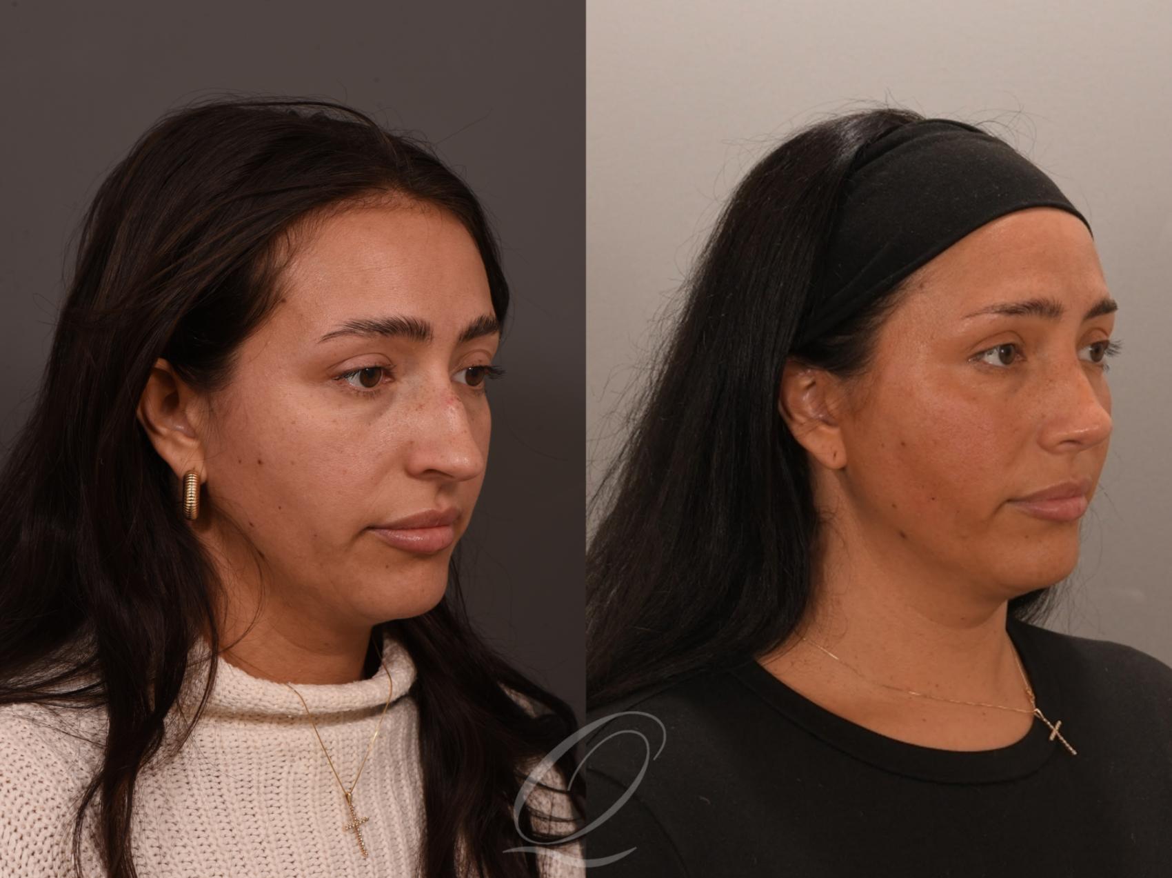 Rhinoplasty Case 1001891 Before & After Left Oblique | Serving Rochester, Syracuse & Buffalo, NY | Quatela Center for Plastic Surgery