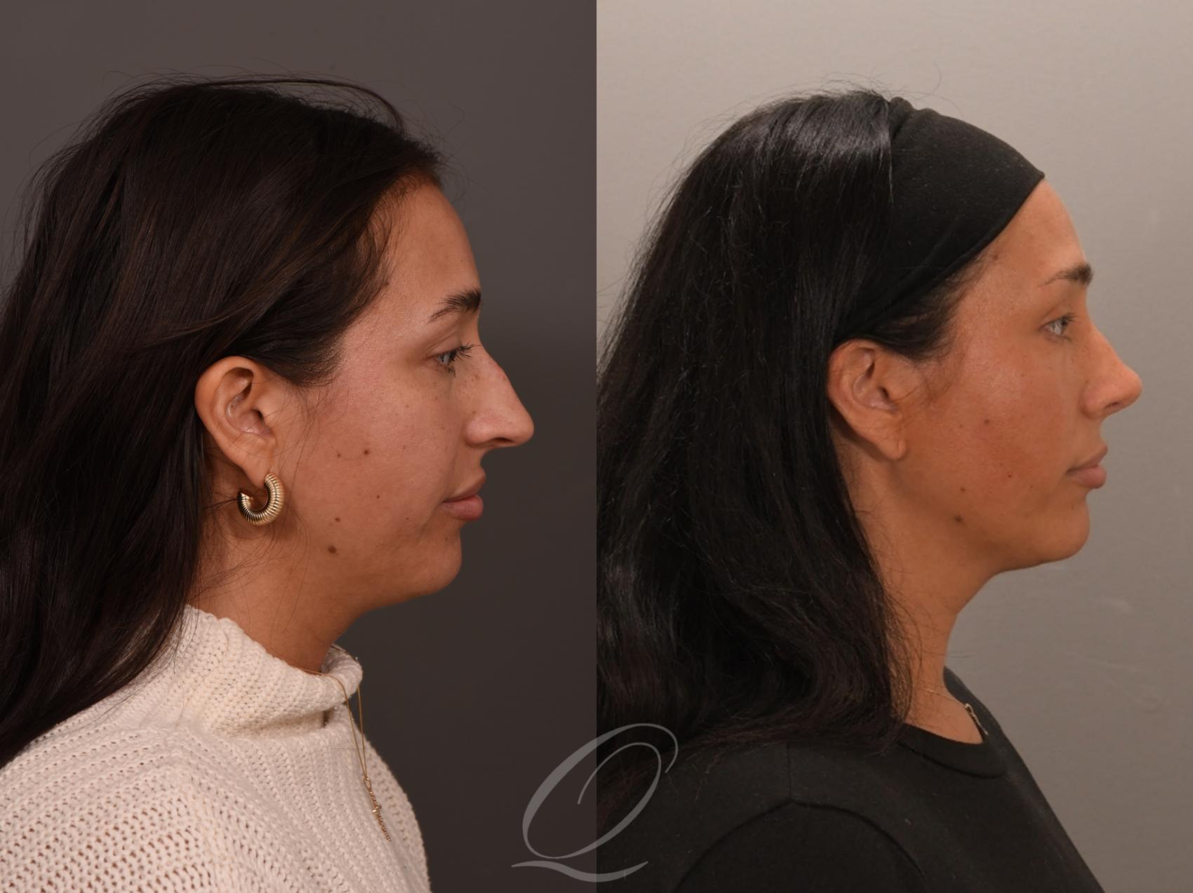 Rhinoplasty Case 1001891 Before & After Left Side | Serving Rochester, Syracuse & Buffalo, NY | Quatela Center for Plastic Surgery