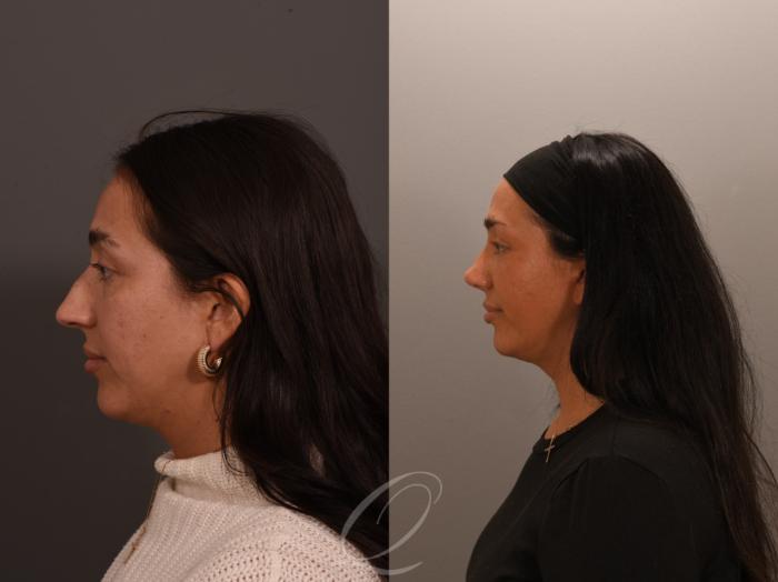 Rhinoplasty Case 1001891 Before & After Right Side 2  | Serving Rochester, Syracuse & Buffalo, NY | Quatela Center for Plastic Surgery