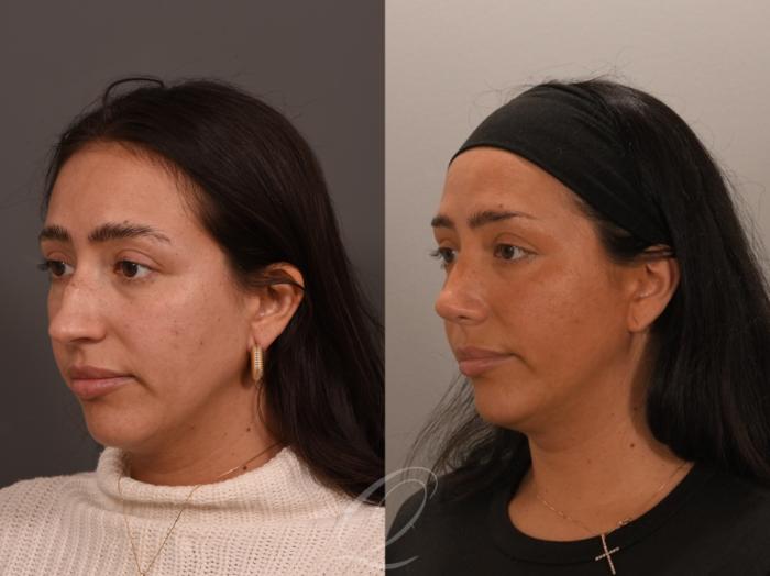 Rhinoplasty Case 1001891 Before & After Right Side | Serving Rochester, Syracuse & Buffalo, NY | Quatela Center for Plastic Surgery
