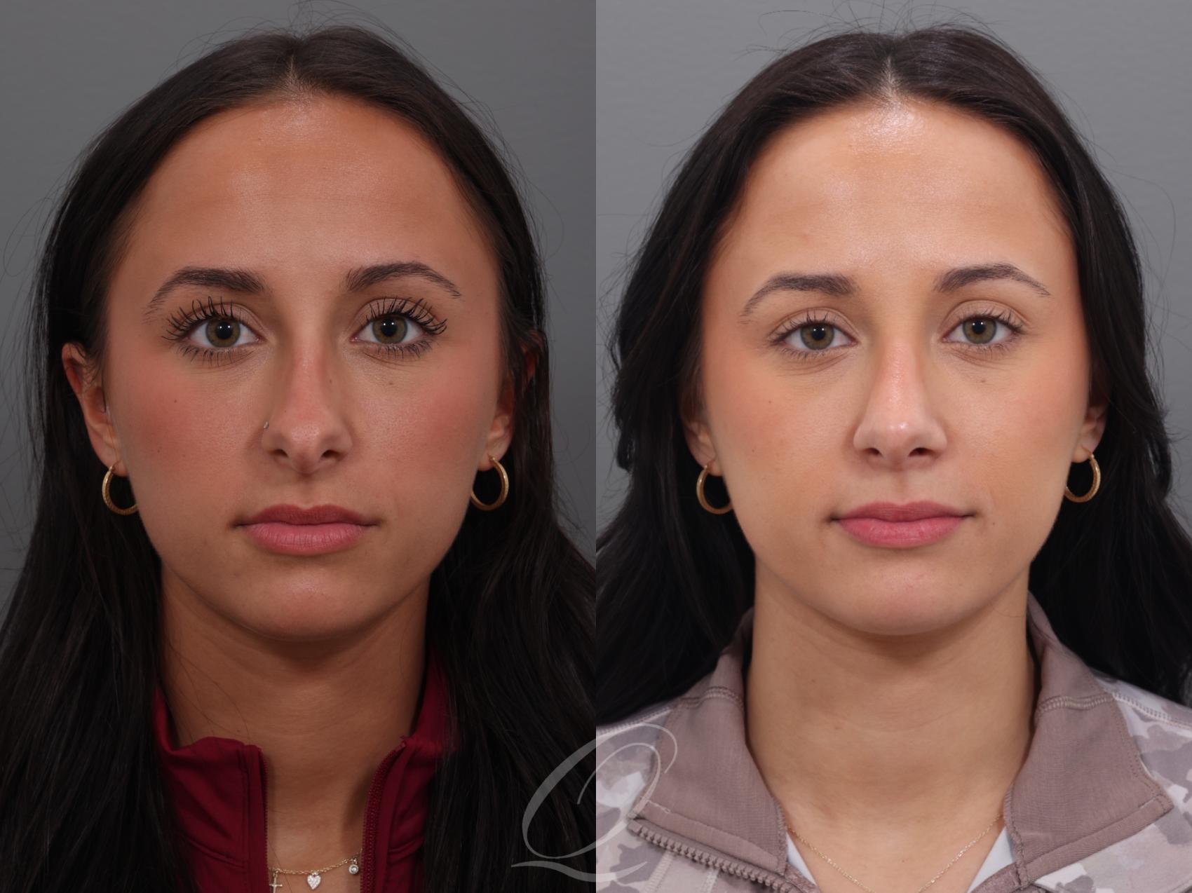 Rhinoplasty Case 1001938 Before & After Front | Serving Rochester, Syracuse & Buffalo, NY | Quatela Center for Plastic Surgery
