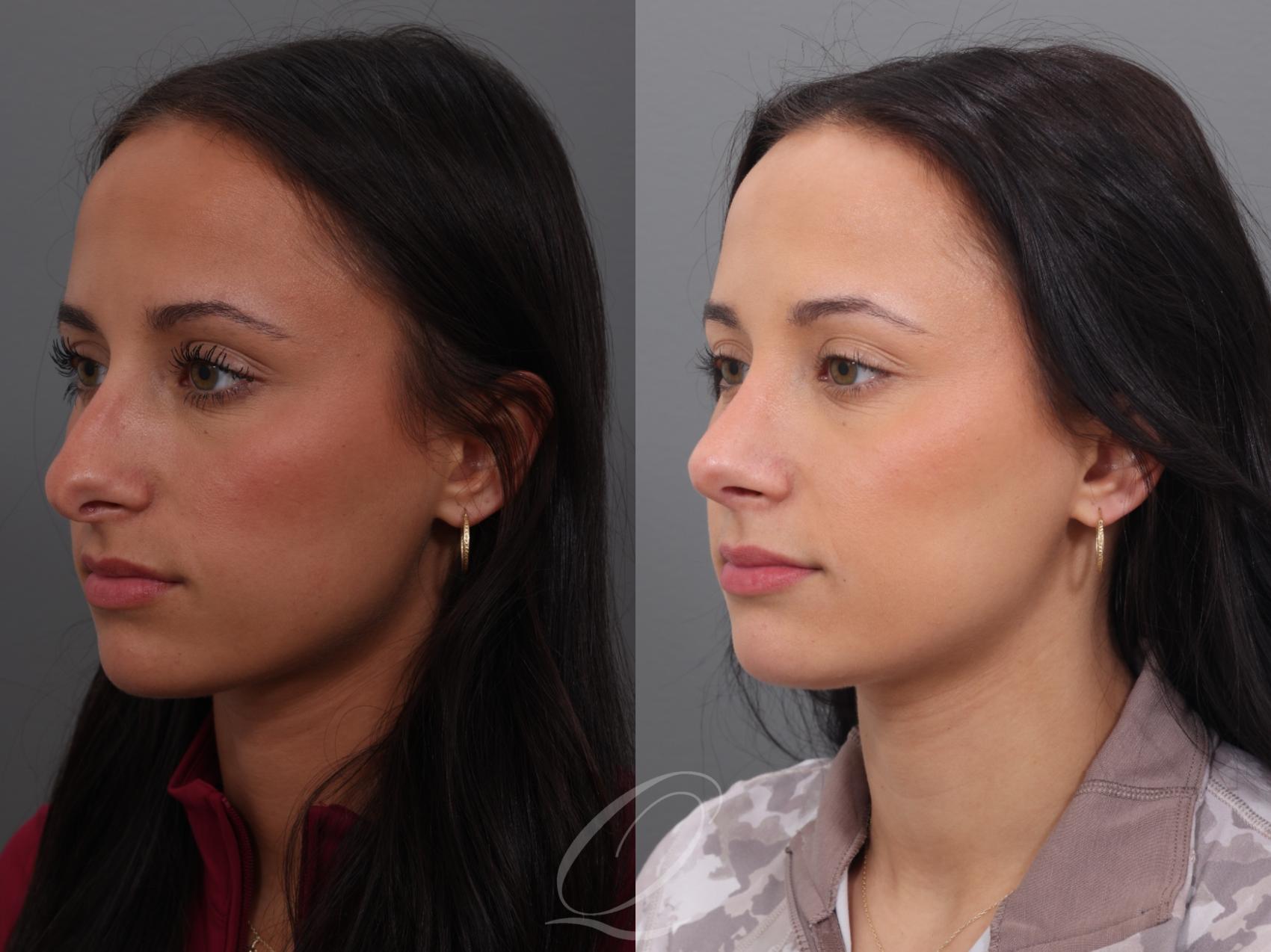 Rhinoplasty Case 1001938 Before & After Left Oblique | Serving Rochester, Syracuse & Buffalo, NY | Quatela Center for Plastic Surgery