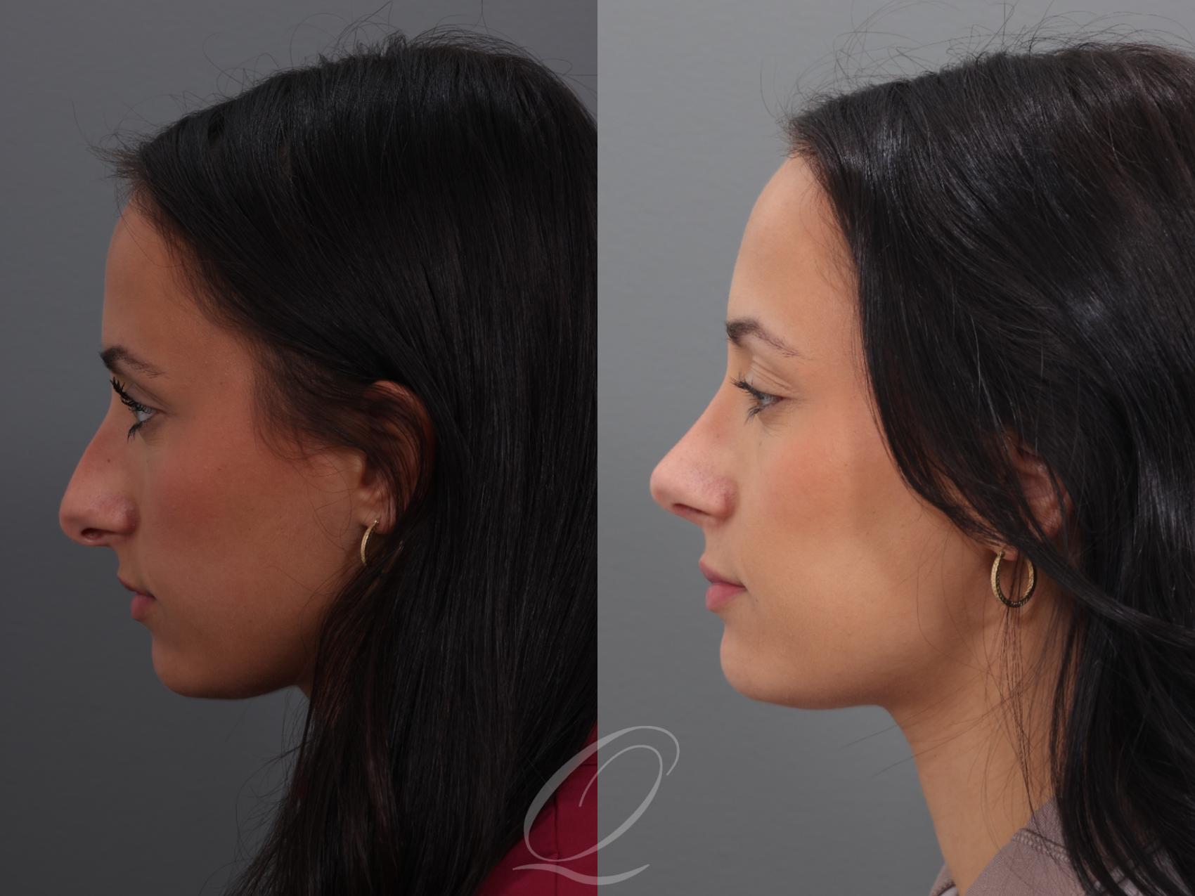 Rhinoplasty Case 1001938 Before & After Left Side | Serving Rochester, Syracuse & Buffalo, NY | Quatela Center for Plastic Surgery