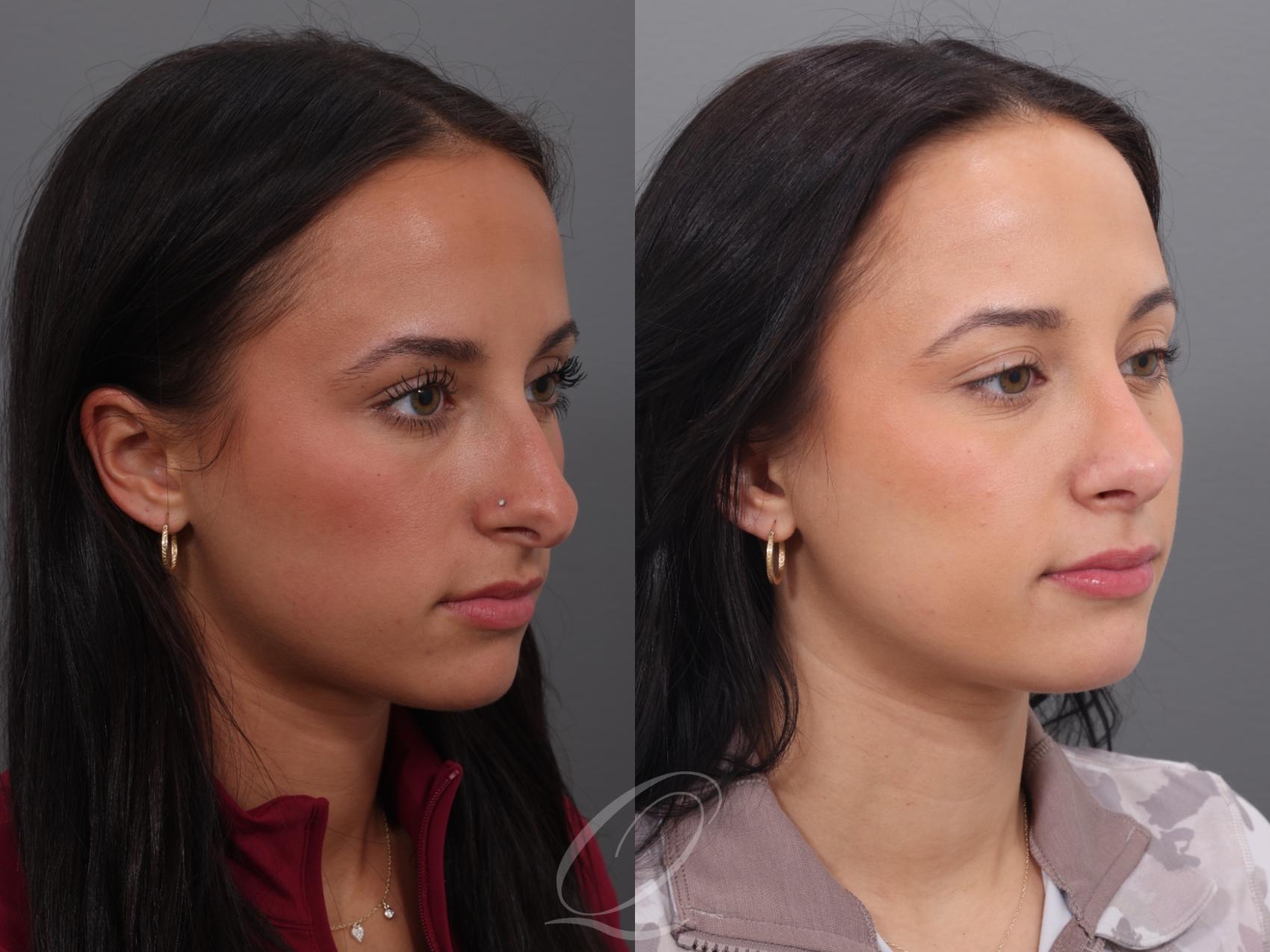 Rhinoplasty Case 1001938 Before & After Right Oblique | Serving Rochester, Syracuse & Buffalo, NY | Quatela Center for Plastic Surgery