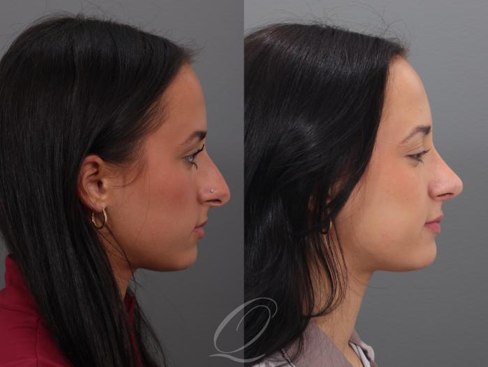 Rhinoplasty Case 1001938 Before & After Right Side | Serving Rochester, Syracuse & Buffalo, NY | Quatela Center for Plastic Surgery