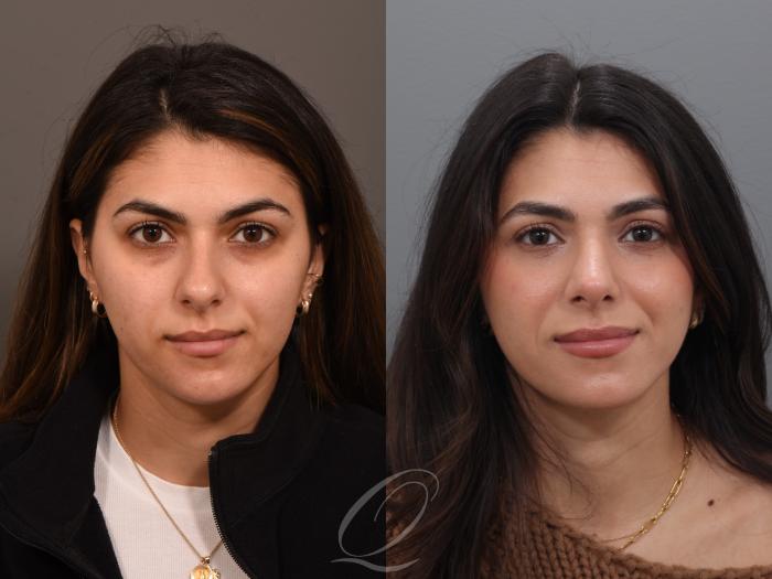 Rhinoplasty Case 1001939 Before & After Front | Serving Rochester, Syracuse & Buffalo, NY | Quatela Center for Plastic Surgery