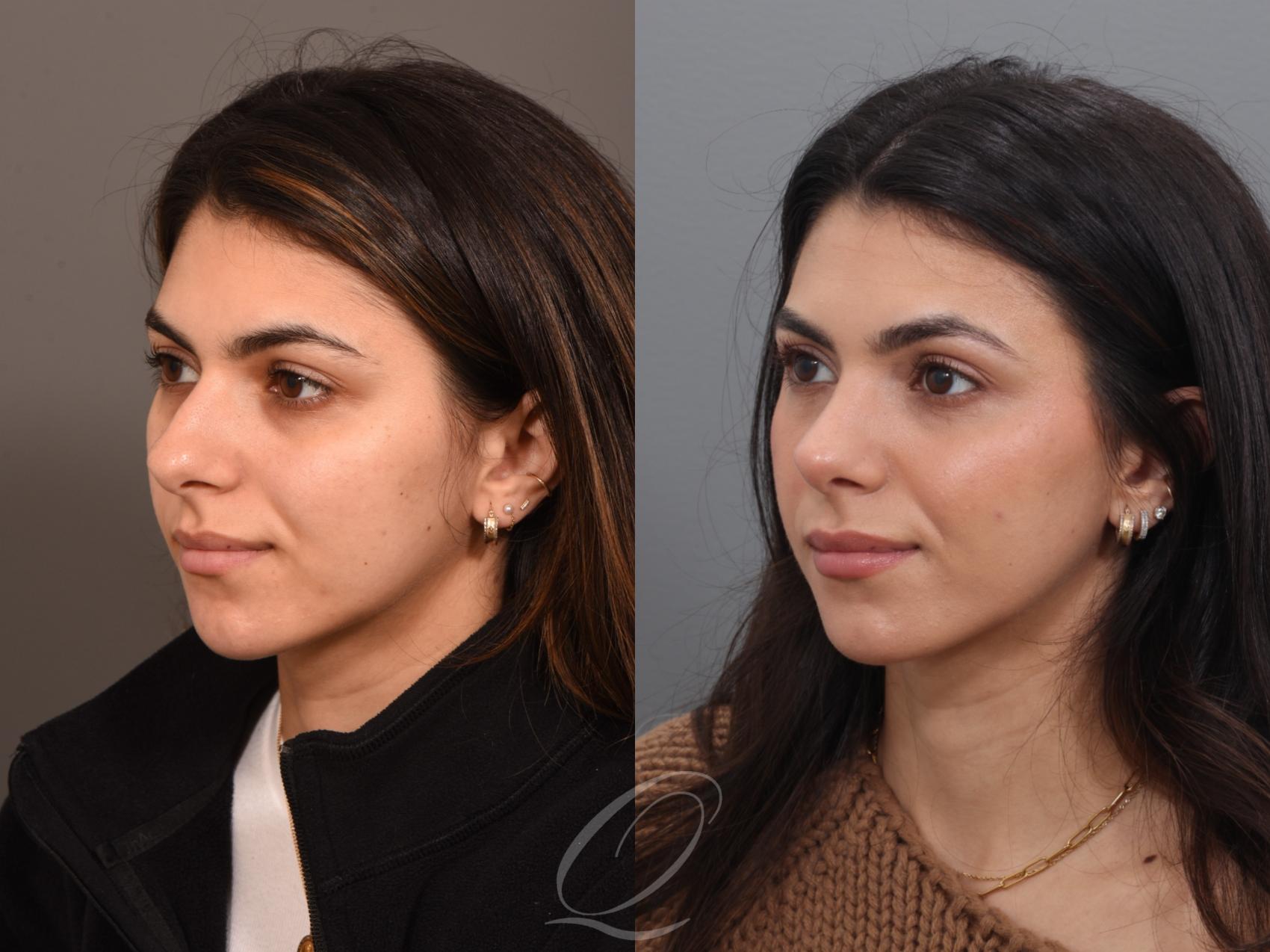Rhinoplasty Case 1001939 Before & After Left Oblique | Serving Rochester, Syracuse & Buffalo, NY | Quatela Center for Plastic Surgery