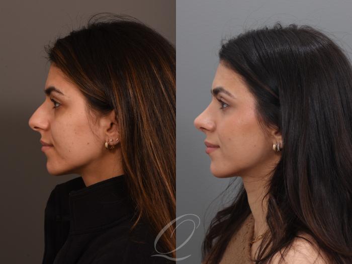 Rhinoplasty Case 1001939 Before & After Left Side | Serving Rochester, Syracuse & Buffalo, NY | Quatela Center for Plastic Surgery