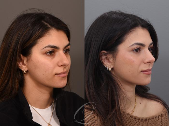 Rhinoplasty Case 1001939 Before & After Right Oblique | Serving Rochester, Syracuse & Buffalo, NY | Quatela Center for Plastic Surgery