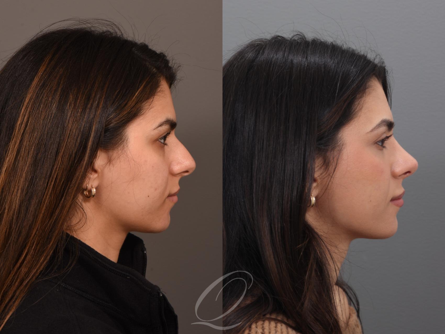 Rhinoplasty Case 1001939 Before & After Right Side | Serving Rochester, Syracuse & Buffalo, NY | Quatela Center for Plastic Surgery