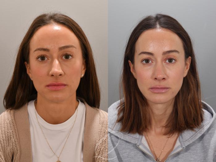 Rhinoplasty Case 1001947 Before & After Front | Serving Rochester, Syracuse & Buffalo, NY | Quatela Center for Plastic Surgery