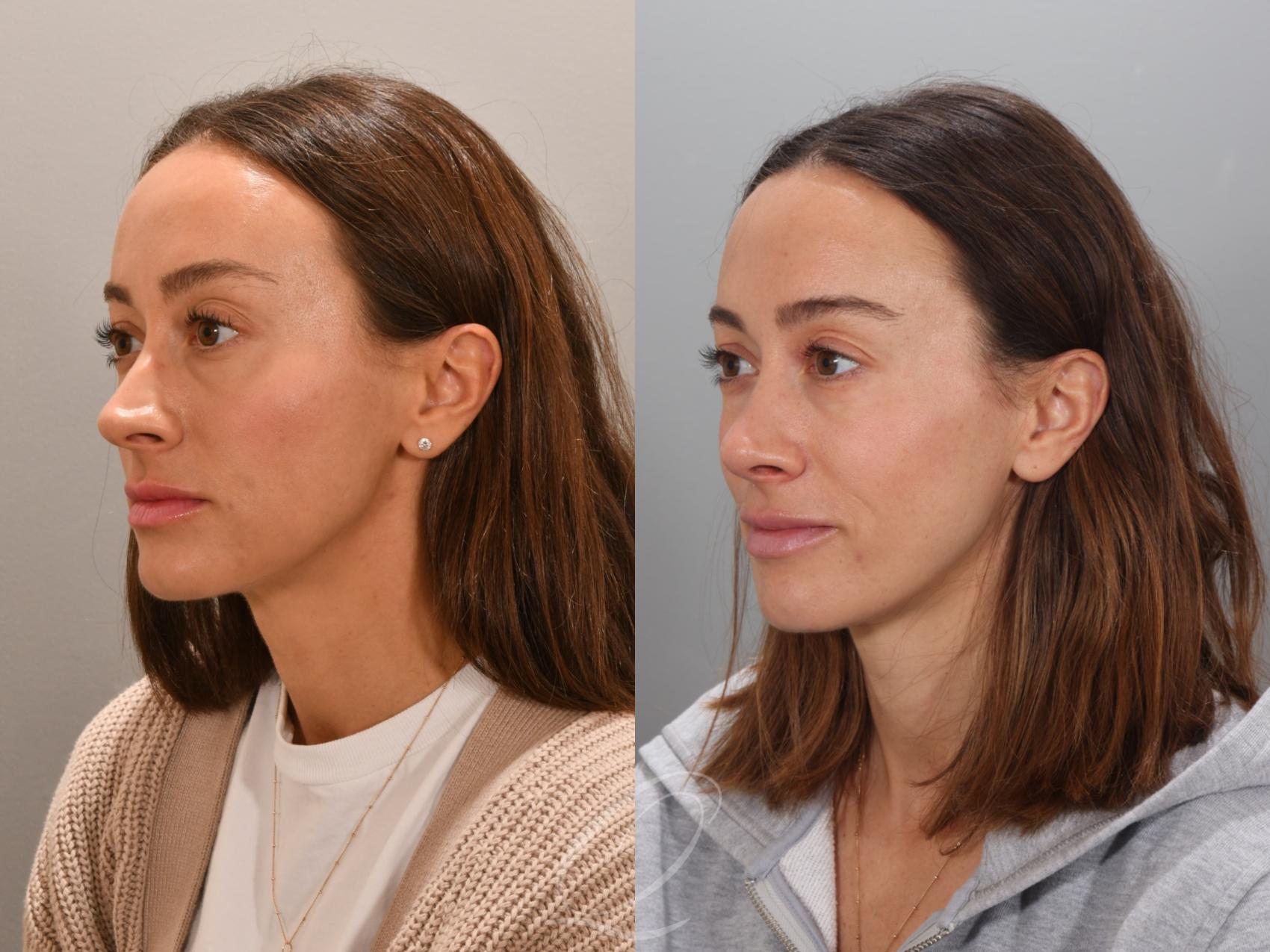 Rhinoplasty Case 1001947 Before & After Left Oblique | Serving Rochester, Syracuse & Buffalo, NY | Quatela Center for Plastic Surgery