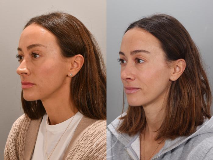 Rhinoplasty Case 1001947 Before & After Left Oblique | Serving Rochester, Syracuse & Buffalo, NY | Quatela Center for Plastic Surgery