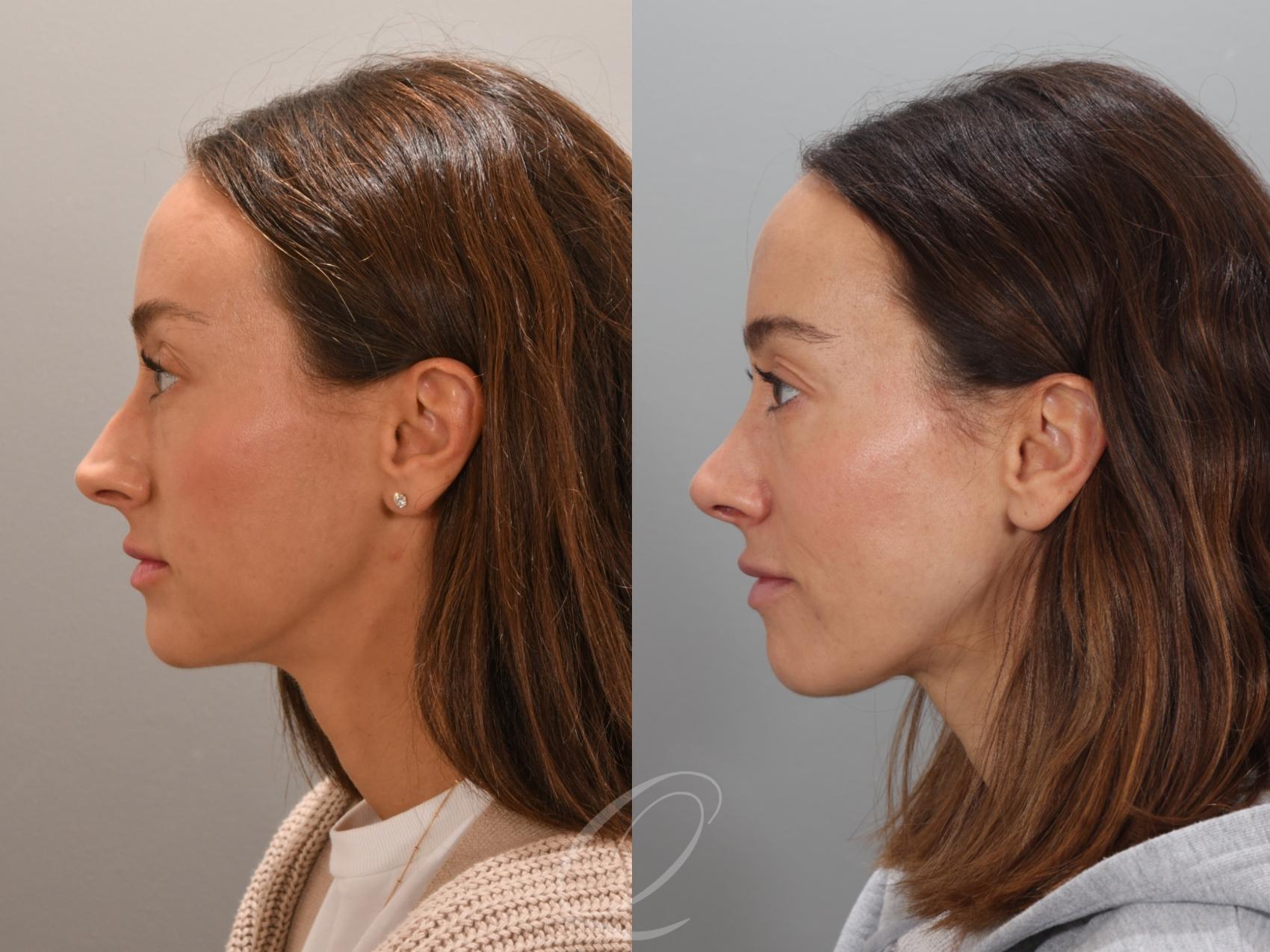 Rhinoplasty Case 1001947 Before & After Left Side | Serving Rochester, Syracuse & Buffalo, NY | Quatela Center for Plastic Surgery