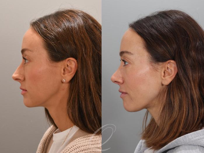Rhinoplasty Case 1001947 Before & After Left Side | Serving Rochester, Syracuse & Buffalo, NY | Quatela Center for Plastic Surgery