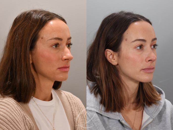 Rhinoplasty Case 1001947 Before & After Right Oblique | Serving Rochester, Syracuse & Buffalo, NY | Quatela Center for Plastic Surgery