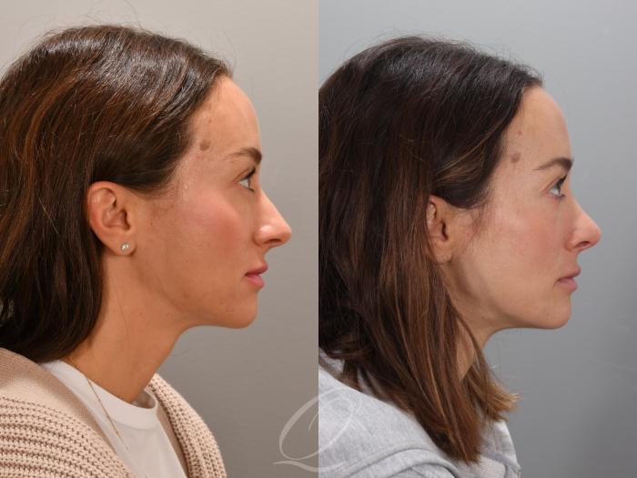 Rhinoplasty Case 1001947 Before & After Right Side | Serving Rochester, Syracuse & Buffalo, NY | Quatela Center for Plastic Surgery
