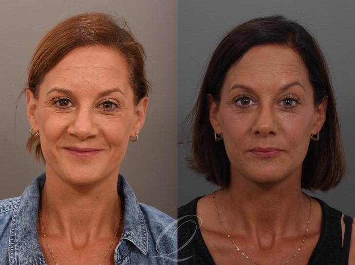 Rhinoplasty Case 1001948 Before & After Front | Serving Rochester, Syracuse & Buffalo, NY | Quatela Center for Plastic Surgery