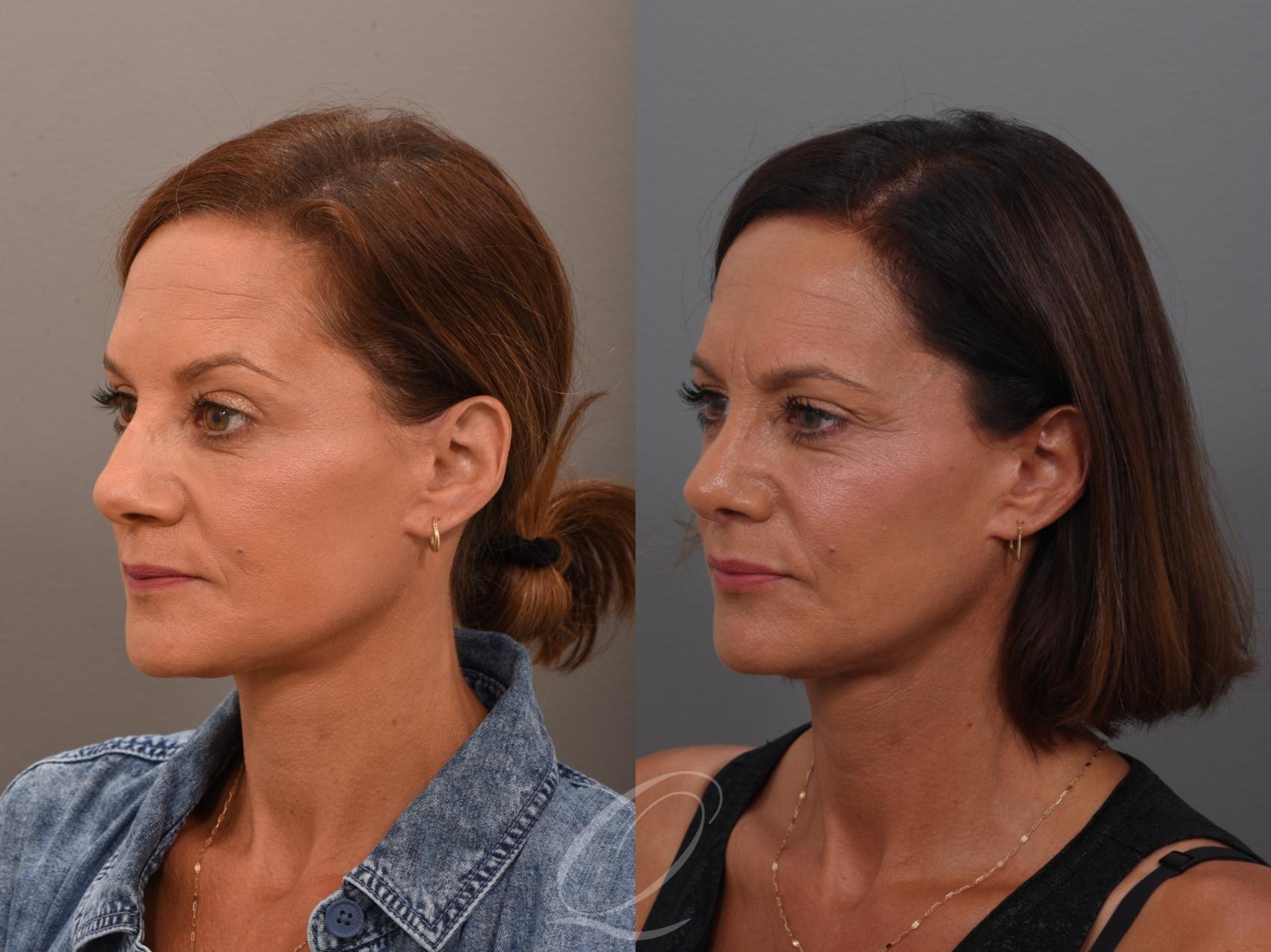 Rhinoplasty Case 1001948 Before & After Left Oblique | Serving Rochester, Syracuse & Buffalo, NY | Quatela Center for Plastic Surgery