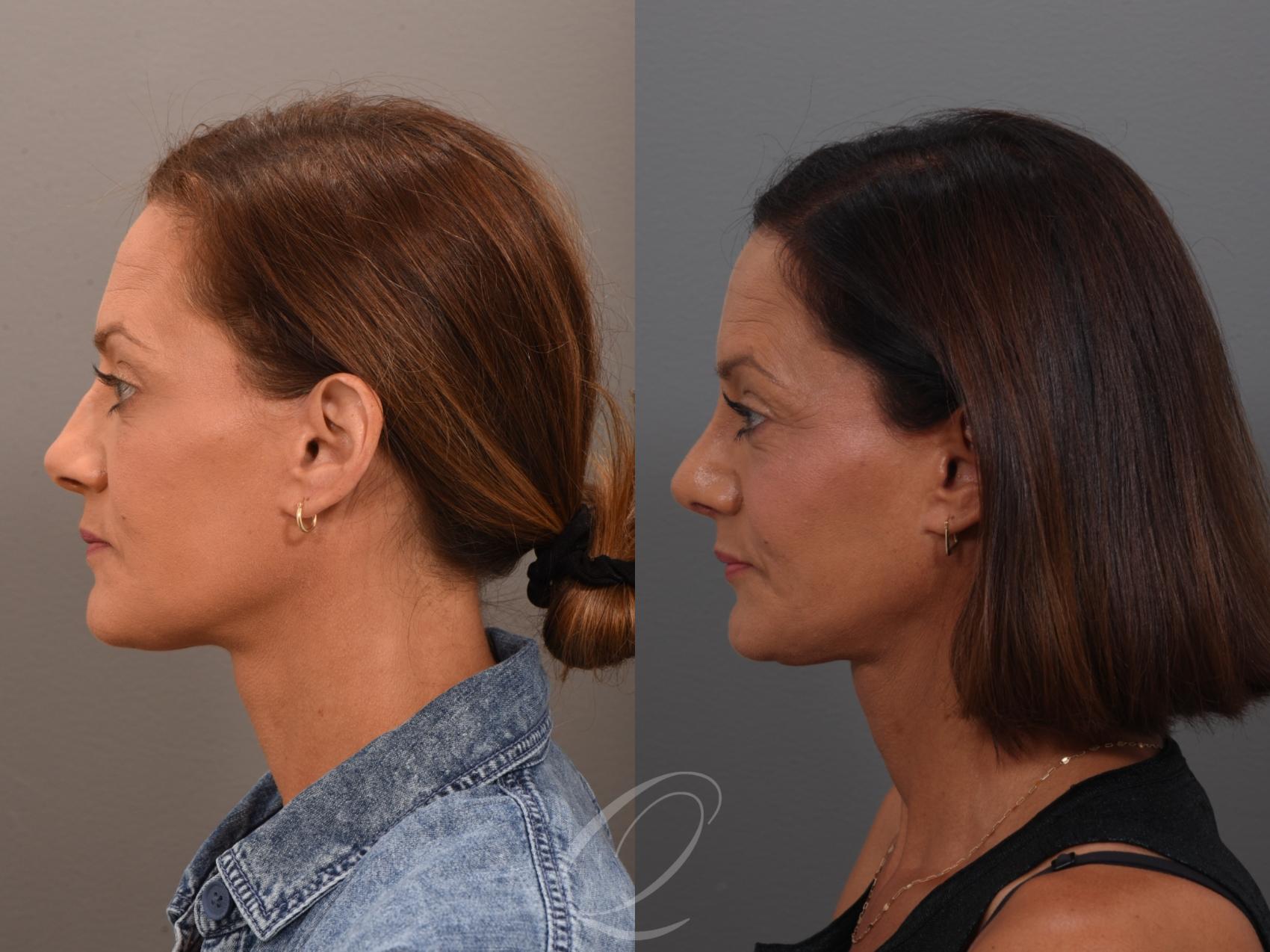 Rhinoplasty Case 1001948 Before & After Left Side | Serving Rochester, Syracuse & Buffalo, NY | Quatela Center for Plastic Surgery