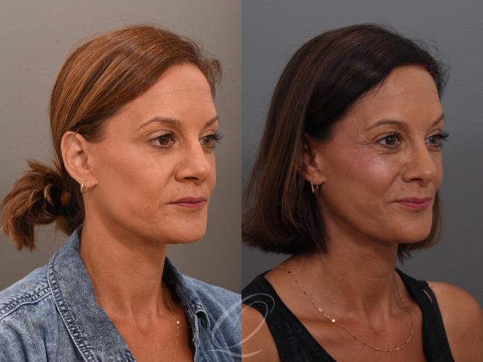 Rhinoplasty Case 1001948 Before & After Right Oblique | Serving Rochester, Syracuse & Buffalo, NY | Quatela Center for Plastic Surgery
