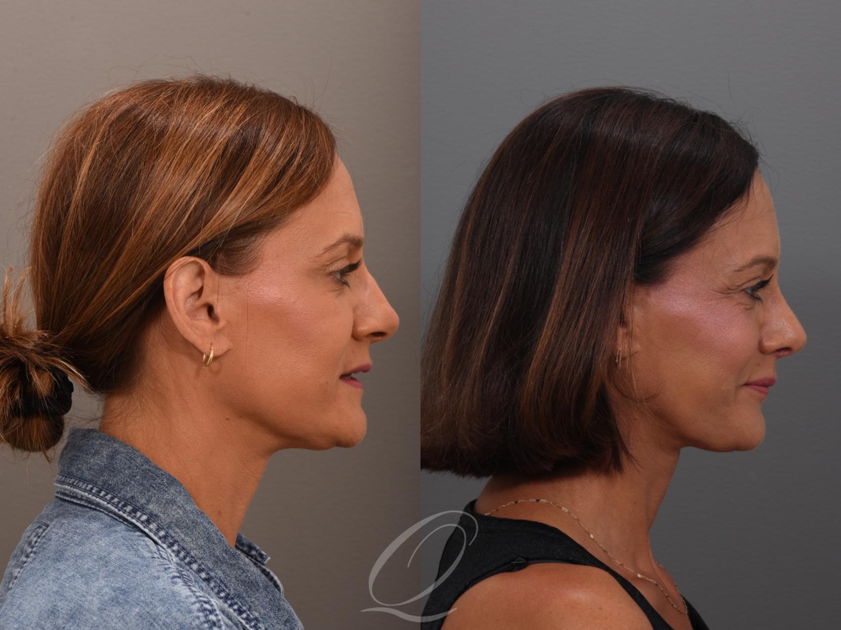 Rhinoplasty Case 1001948 Before & After Right Side | Serving Rochester, Syracuse & Buffalo, NY | Quatela Center for Plastic Surgery