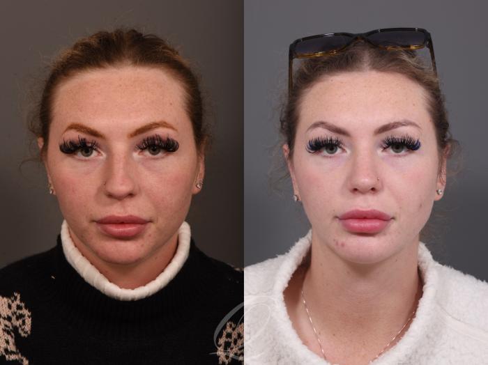 Rhinoplasty Case 1001950 Before & After Front | Serving Rochester, Syracuse & Buffalo, NY | Quatela Center for Plastic Surgery