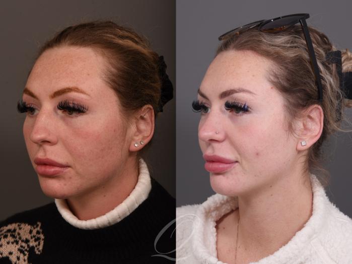 Rhinoplasty Case 1001950 Before & After Left Oblique | Serving Rochester, Syracuse & Buffalo, NY | Quatela Center for Plastic Surgery