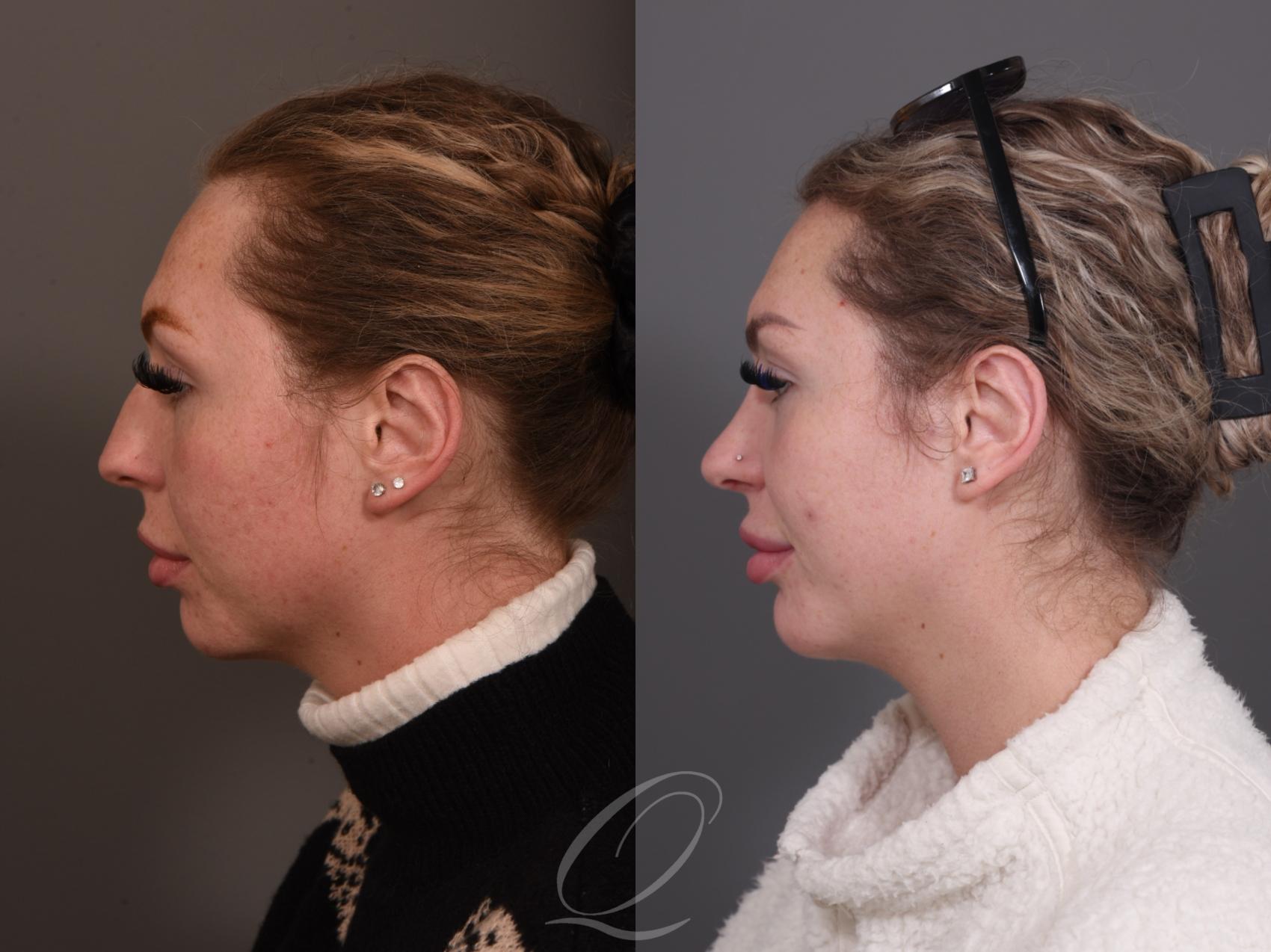 Rhinoplasty Case 1001950 Before & After Left Side | Serving Rochester, Syracuse & Buffalo, NY | Quatela Center for Plastic Surgery