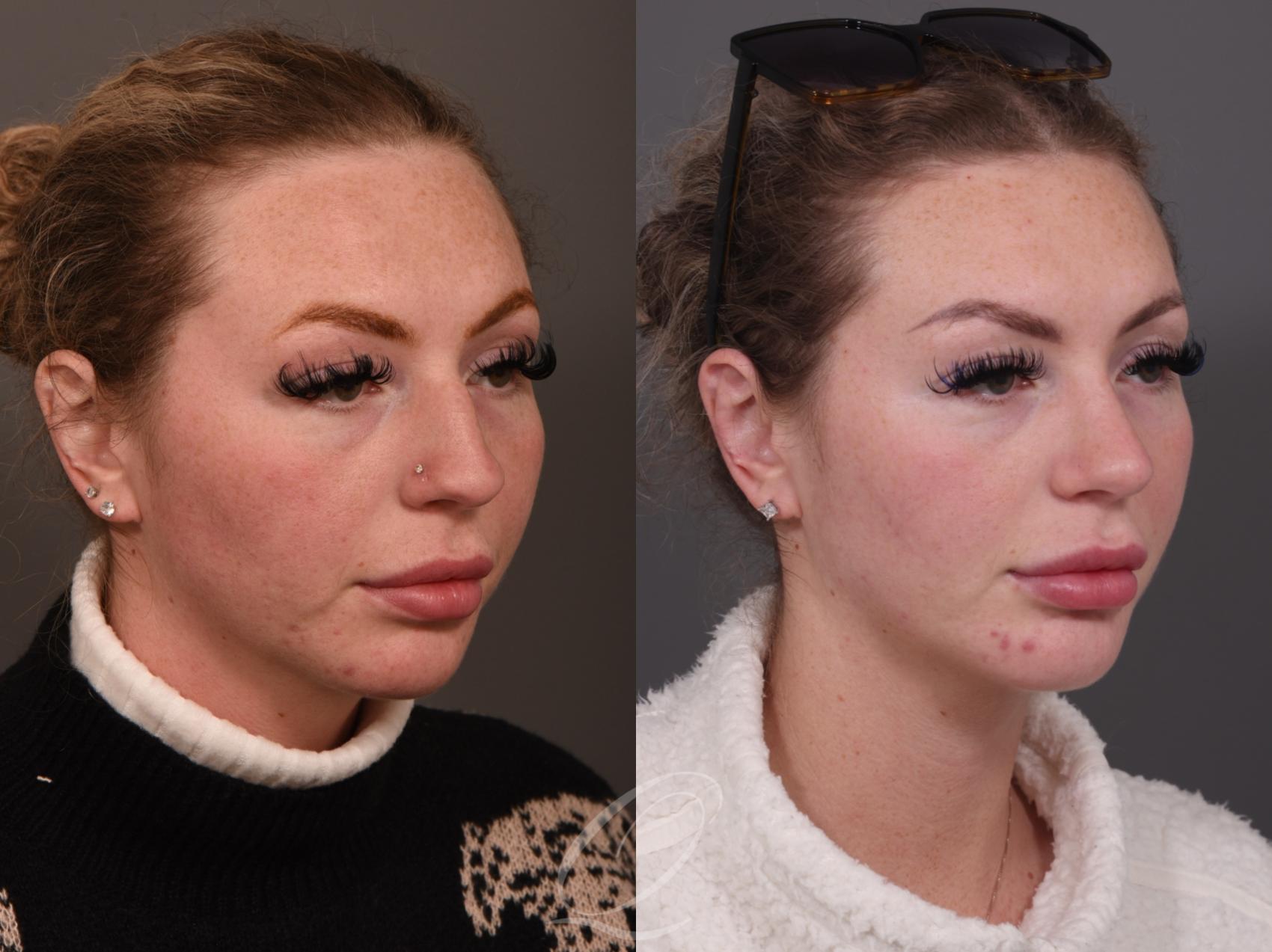 Rhinoplasty Case 1001950 Before & After Right Oblique | Serving Rochester, Syracuse & Buffalo, NY | Quatela Center for Plastic Surgery