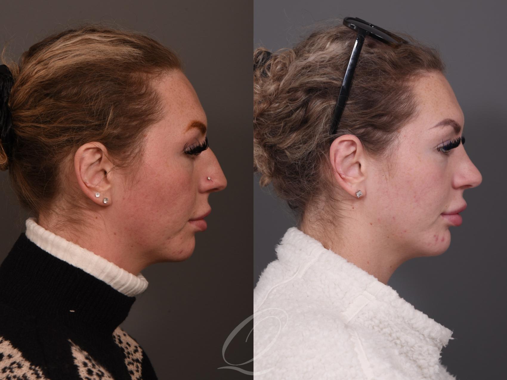 Rhinoplasty Case 1001950 Before & After Right Side | Serving Rochester, Syracuse & Buffalo, NY | Quatela Center for Plastic Surgery