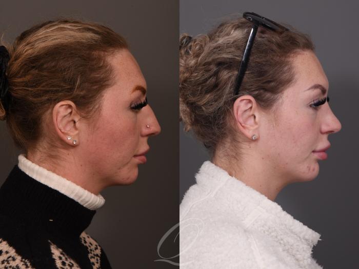 Rhinoplasty Case 1001950 Before & After Right Side | Serving Rochester, Syracuse & Buffalo, NY | Quatela Center for Plastic Surgery