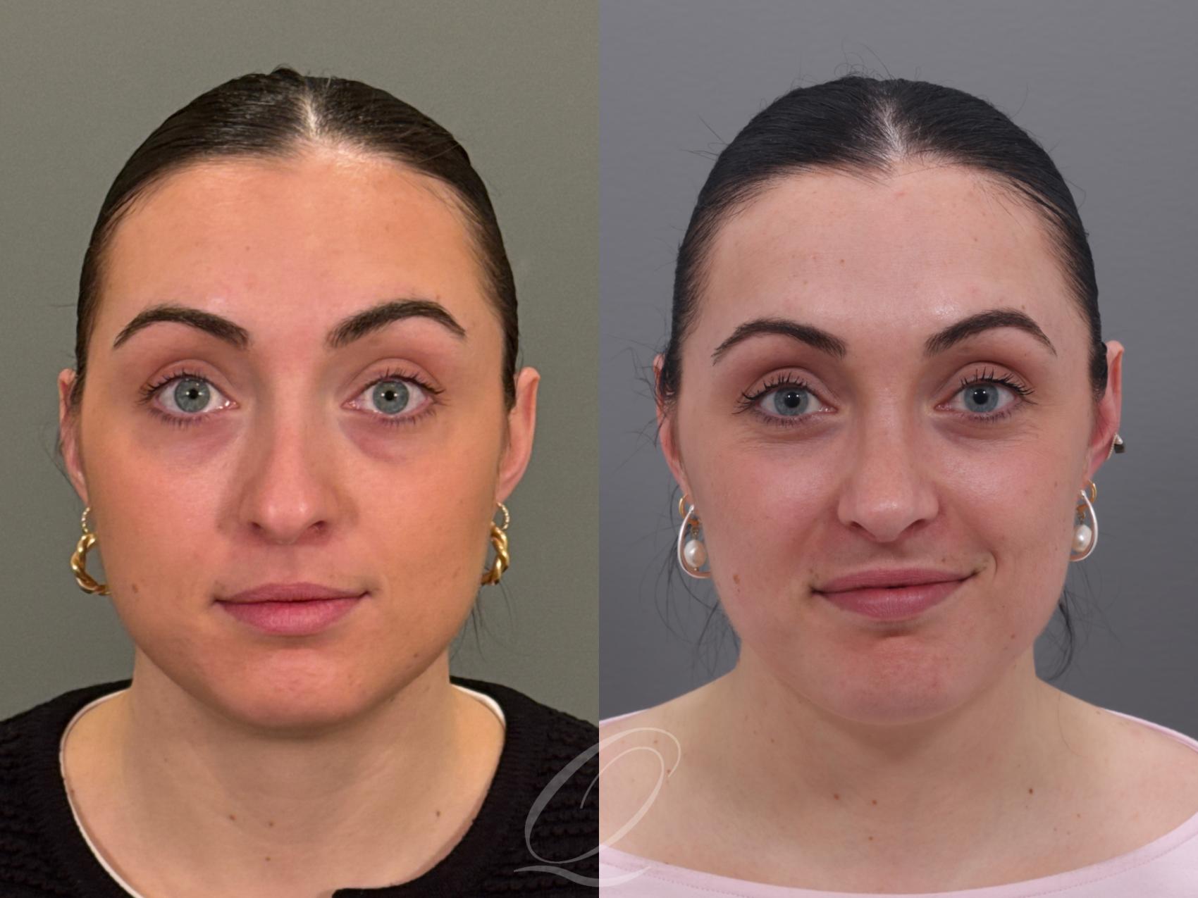 Rhinoplasty Case 1001965 Before & After Front | Serving Rochester, Syracuse & Buffalo, NY | Quatela Center for Plastic Surgery