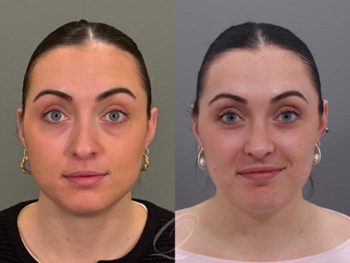 Rhinoplasty Case 1001965 Before & After Front | Serving Rochester, Syracuse & Buffalo, NY | Quatela Center for Plastic Surgery