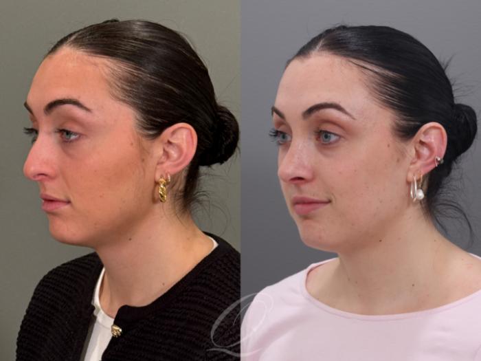 Rhinoplasty Case 1001965 Before & After Left Oblique | Serving Rochester, Syracuse & Buffalo, NY | Quatela Center for Plastic Surgery