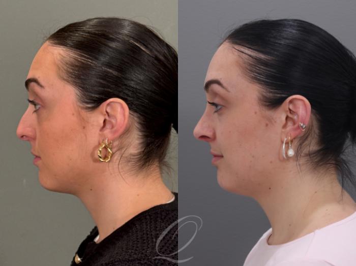 Rhinoplasty Case 1001965 Before & After Left Side | Serving Rochester, Syracuse & Buffalo, NY | Quatela Center for Plastic Surgery