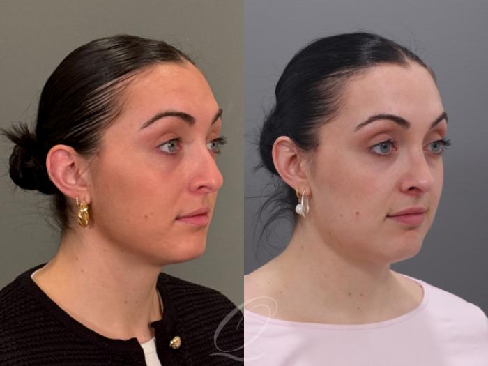 Rhinoplasty Case 1001965 Before & After Right Oblique | Serving Rochester, Syracuse & Buffalo, NY | Quatela Center for Plastic Surgery