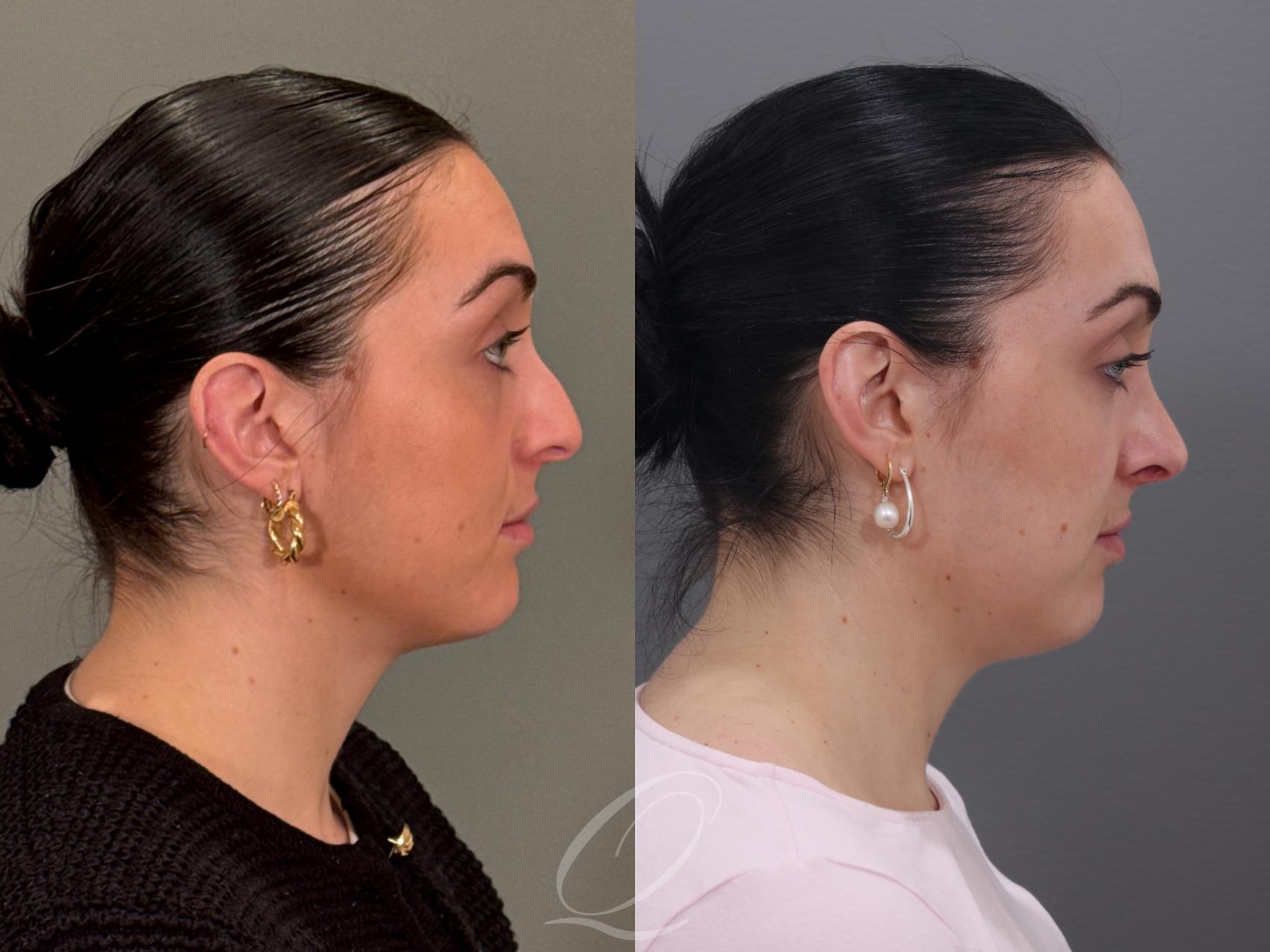 Rhinoplasty Case 1001965 Before & After Right Side | Serving Rochester, Syracuse & Buffalo, NY | Quatela Center for Plastic Surgery