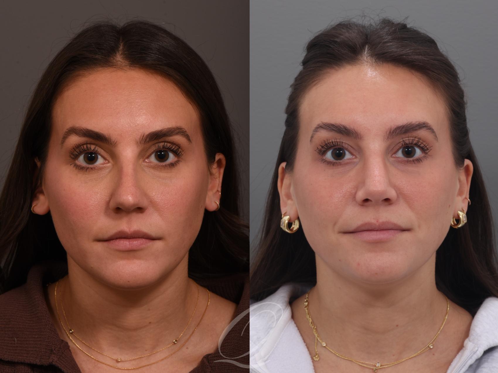 Rhinoplasty Case 1001970 Before & After Front | Serving Rochester, Syracuse & Buffalo, NY | Quatela Center for Plastic Surgery